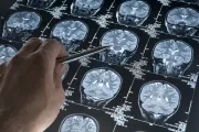Alzheimer'da gençlik proteini keşfi